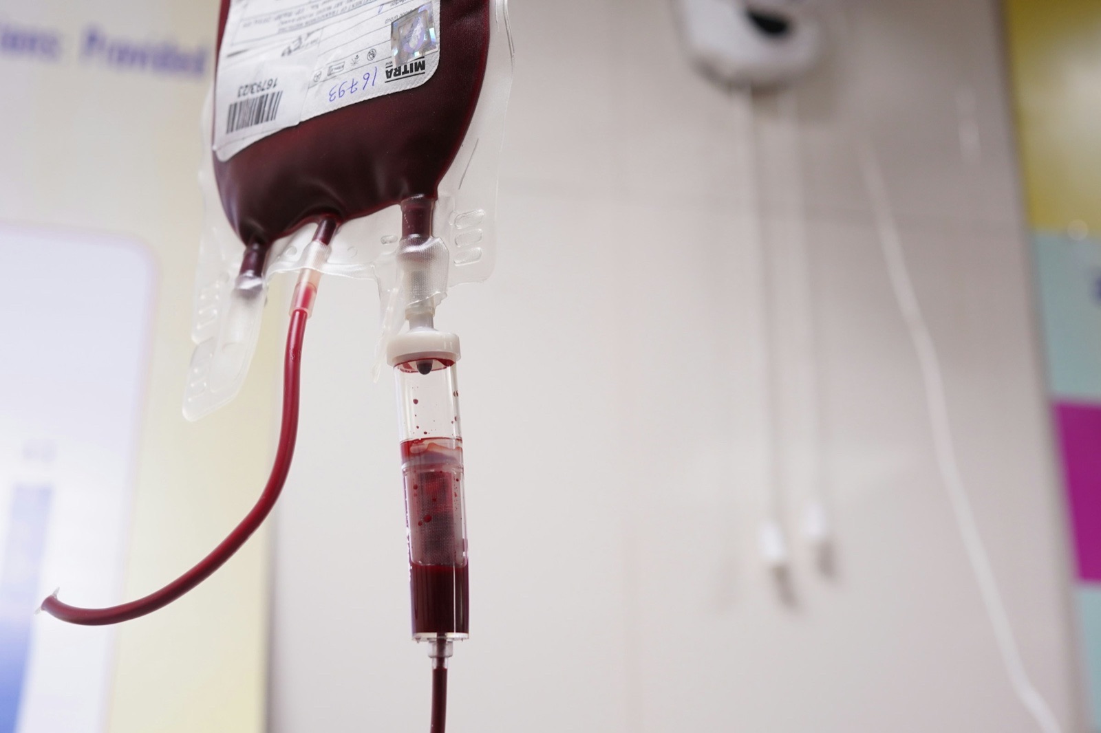 A bag of blood with a drip chamber and tubing hanging from a stand in a clinical setting.